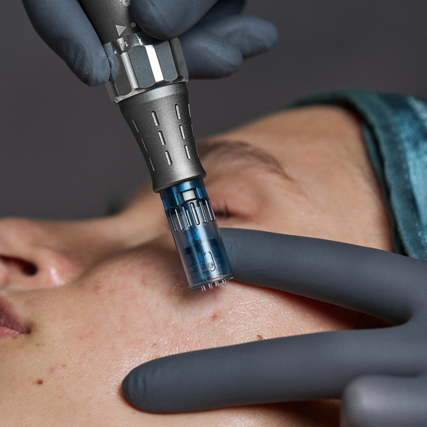 acne scar reduction microneedling