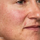 melanopro peel system