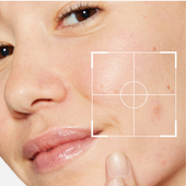 acne and breakouts