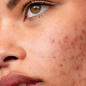 acne and breakouts